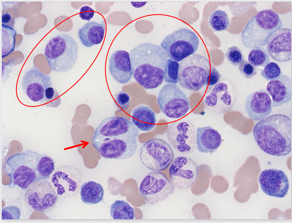 <p>Plasma Cell Diagram Bone Marrow Analysis</p>