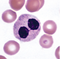 <p>What is the classification, causation, and characteristics of pelger huet anomaly (PHA)?</p>
