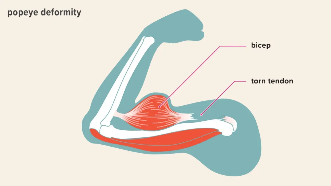 <p><strong>Answer:</strong><br><strong>C) Biceps tendon rupture</strong>, most likely rupture of the <strong>proximal long head of the biceps tendon</strong>.</p><p></p><p><strong>Key clues:</strong></p><ul><li><p>Sudden onset after heavy lifting</p></li><li><p>Older patient with chronic shoulder disease</p></li><li><p>Anterior upper-arm bulge = <strong>“Popeye” deformity</strong></p></li><li><p>Pain or weakness with elbow flexion/supination</p></li><li><p>Normal elbow extension because the triceps is intact</p></li></ul><p class=""><strong>Flashcard rule:</strong><br><strong>Heavy lifting + sudden upper-arm bulge in an older adult → proximal biceps tendon rupture.</strong><br><br><br><strong>Treatment:</strong><br>Usually <strong>conservative management</strong>:</p><ul><li><p>Rest and avoid painful lifting</p></li><li><p>Ice and NSAIDs/acetaminophen</p></li><li><p>Physical therapy to restore shoulder and elbow strength</p></li></ul><p>A proximal long-head biceps rupture usually does <strong>not</strong> require surgical repair because the short head remains attached and function is largely preserved. Surgery, usually <strong>biceps tenodesis</strong>, is considered for persistent pain/cramping, substantial weakness, associated shoulder pathology, or high-demand patients.</p><p><strong>Flashcard rule:</strong><br><strong>Proximal biceps rupture → conservative treatment.</strong><br><strong>Distal biceps rupture → surgical repair</strong>, especially in active patients, because it causes major supination weakness.</p>