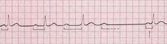 <p>progressive lengthening of PR interval until wave is not followed by conducted QRS complex</p><p><em>(variable RR, regulary irregular)</em></p><p><em>rx: usually none. asymp. </em></p>