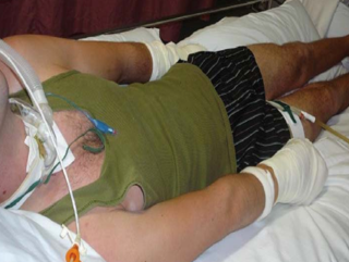 <p><mark data-color="yellow" style="background-color: yellow; color: inherit;">Sympathetic storming—Paroxysmal sympathetic hyperactivity </mark></p>