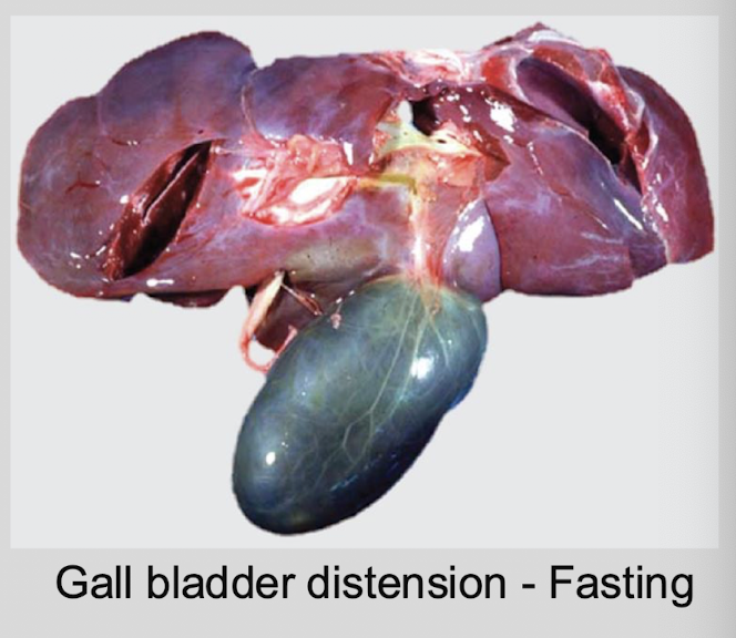<p>enlarged &amp; thin walled, filled with bile → NOT a pathologic condition</p>