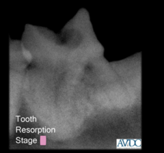 <p>what stage of tooth resorption is this?</p>