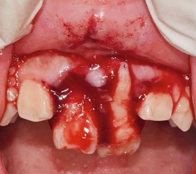 <p>treat hard tissue first!</p><p>sutures may loosen or tear during manipulation</p><p>once lost, tissue closure is harder on a second attempt</p>