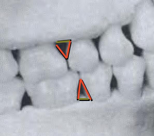 <p>The <span style="color: rgb(255, 74, 253);"><strong><u>apex</u></strong></span> of the “triangle” of the Gingival embrasure is known as the</p>