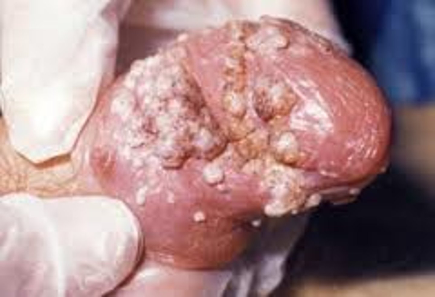 <p>- asymptomatic white, exophytic, papillary growths, small at first, test to coalesce, affect vulva, vagina, &amp; cervix penis, scrotum, pubis, perianal, oropharyngeal. Grow to large cauliflower masses</p><p>-cause: HPV (6 &amp; 11)</p><p>- biopsy to rule out neoplasia</p><p>- incubation: weeks to years</p><p>- Tx: by provider: B. acid or T. acid, podophyllin in tincture of benzoin, cryosurgery, electrosurgery, laser. By pt: podofilox gel, imiquimod cream</p>