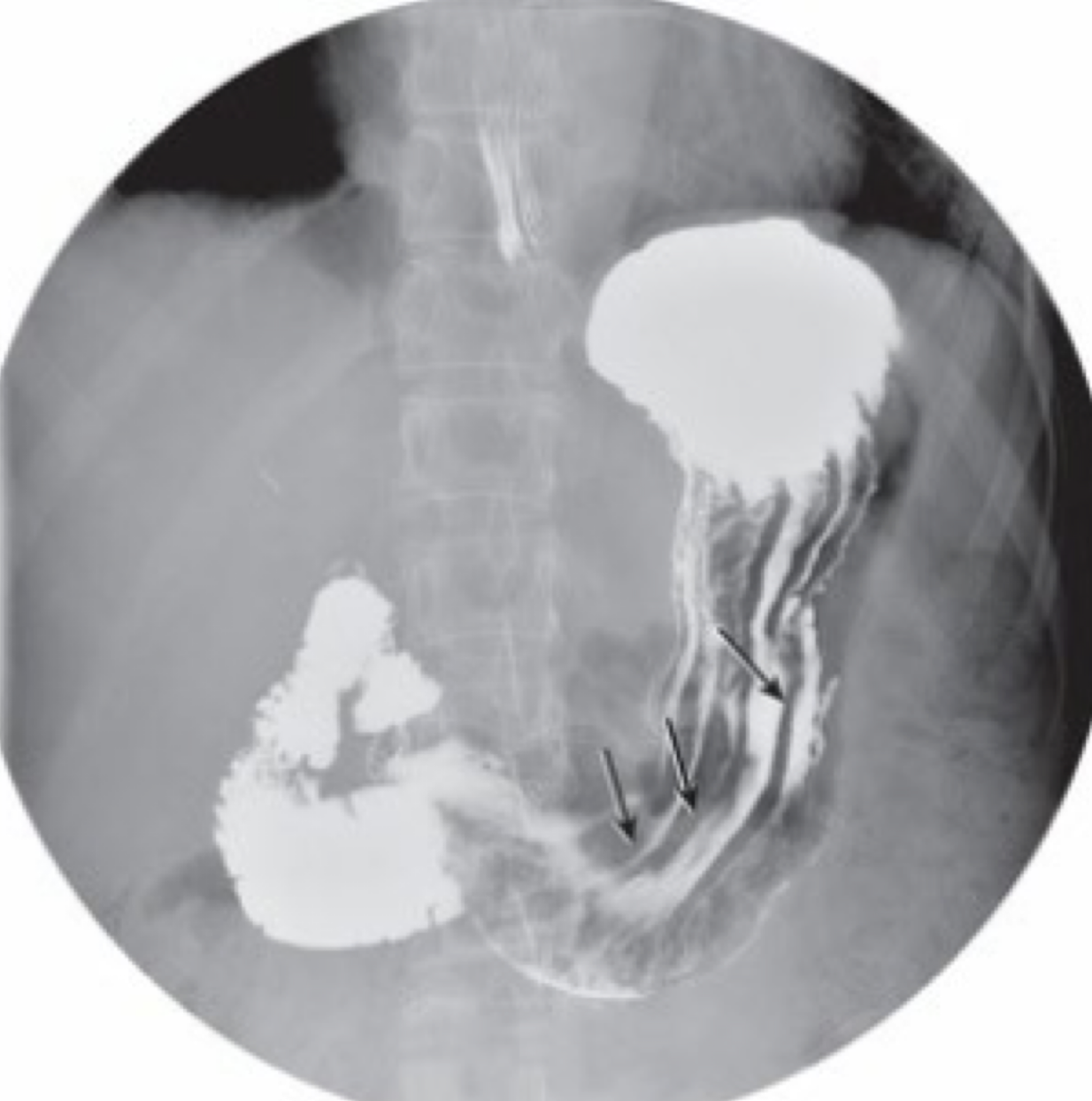 <p>Demonstrates: entire stomach and duodenum</p><p>Clinical indication: hiatal hernia</p>