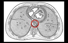 <p>This is a transverse section of the thorax, which of the following structure is NOT located within the red circle?</p><p>Aorta</p><p>Azygos vein</p><p>Esophagus</p><p>Intercostal nerve</p>