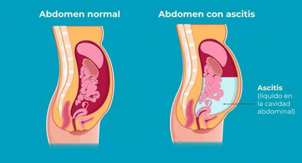 <p>Acumulación anormal de líquido dentro de la cavidad peritoneal</p>