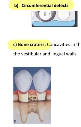 <p>Angular defects</p><p>Circumferential defects- cicrcular wall of destruction </p><p>Bone craters- if 2 circular defects connect next to each other</p><p>Hemiseptal defect- bone crater loses one of its outer walls </p>
