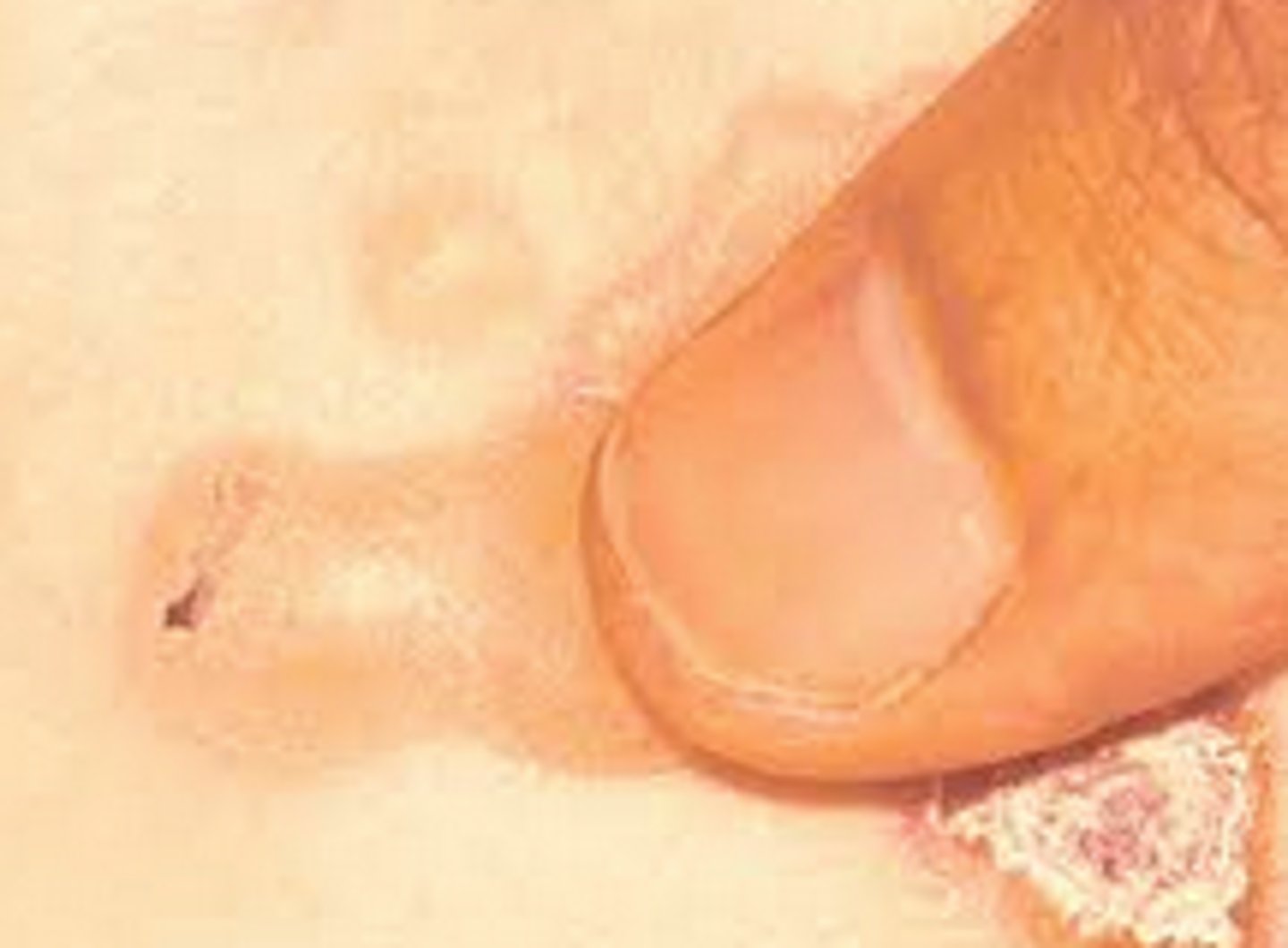 <p>The Asboe-Hansen sign is the lateral extension of bullae with pressure and is a diagnostic feature of toxic epidermal necrolysis.</p>