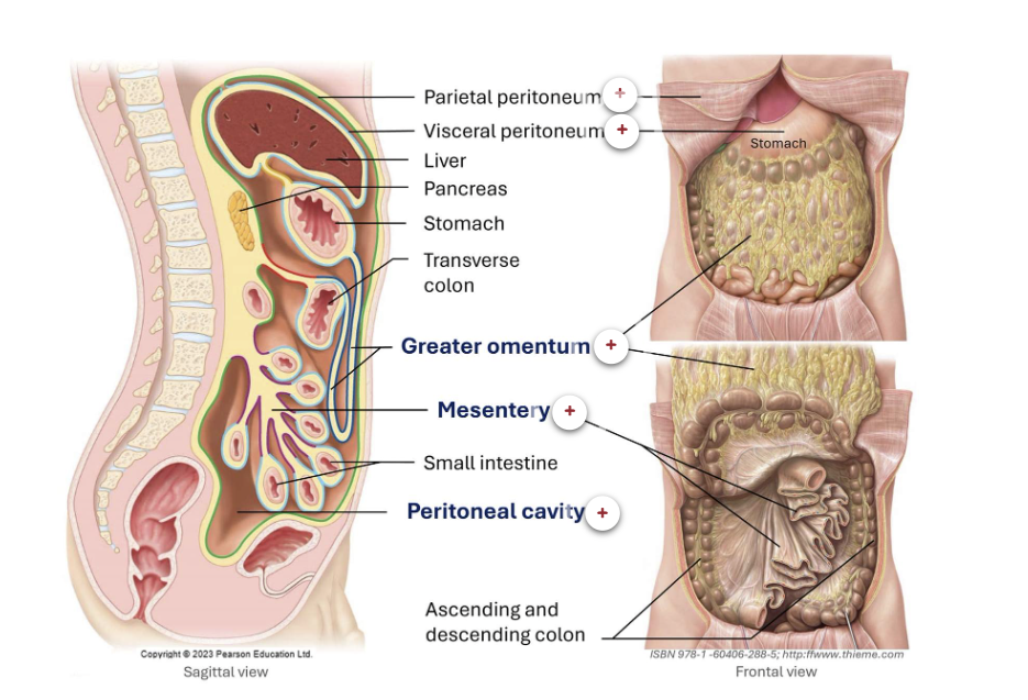 <p><mark data-color="purple" style="background-color: purple; color: inherit;">Gastrointestinal wall</mark></p><p>The wall of the gastrointestial tract, from the lower oesophague to the anal canal has the same basic- 4 layerd arrangement of tissues. These layers, from the inside out, are the mucosa, submusosa, muscularis and serosa </p><ol><li><p>Mucosa- this is the inner layer of the GIT wall. It is compsed of epithelium in direct contact with GIT contents, a layer of aroelar connective tissue and a thin layer of smooth muscle that creates folds to increase the surface area for digestion and absorbtion. The mucosa also contains lymph nodules that protects against pathogens</p></li><li><p>Submucosa- this is a connective tissue layer that binds the musoca to the muscularis. It contains blood and lympthatic vessels that recieve absorbed food moleculaes. It also contains the submucosal plexus </p></li><li><p>Muscularis externa- this is a thick layer of muscle. In the oral cavity, pharynx and upper oesophague, it consists of skeletal muscle important for voluntary control of swallowing. Skeletal muscle also froms the external anal sphincter for defecation. In the rest of the GI tract, distal to the oesophague, the muscualris is composed of smooth muscle layers. The inner layer contains circualr fibres that wrap around the wall, while the outer layer had longituaional fibres that run the length of the wall. Movement of these musclles is involuntary and controlled by the myentric plexus</p></li><li><p>Serosa- this is the outermost layer that is comosed of simple squamous epithelium and areolar connective tissue. It secreates a watery lubricant called serous fluid, which allows the GI tract to glide easily past other organs as it moves around due to digestion</p></li></ol><p></p><p><mark data-color="purple" style="background-color: purple; color: inherit;">Peritoneum</mark></p><p>Most digestive organs are located in the abdomincal cavity, which is lined by a slippery serous membrane called the peritoneum. This membrane has 2 layers, the pariental peritoneum, which lines the abdomincal call and the visceral periotenum which covers the digestive rogans. Between them lies the periotneal cavity, a space containing a small amount of fluid that reduces friction as organs move. </p><p></p><p>The 2 layers are continuous: when the partiental peritoneum folds inwards to envelop the organs, it becomes the cisceral periotenum. </p><p></p><p>Intraperitoneal organs are entirelt enclosed by the visceral peritoneum, except at narrow regions where it reflects onto adjacnt strucutres or the abdomincal wall to become pariental periotenum. These reflections form periotenal folds, such as the mescentrey, which acnhors the small intesting to the posterior abdomincal wall. </p><ul><li><p>stomach</p></li><li><p>small instesting</p></li><li><p>liver</p></li><li><p>transverse colon</p></li></ul><p></p><p>Retroperotoneal organs lie on the posterior abdomincal wall behind the parietal peritoneum and are covered by the peroteum only on their anteropr surfaces</p><ul><li><p>kidney</p></li><li><p>ureters</p></li><li><p>pancreas</p></li></ul><p></p><p>The peritoneal cavity is a fluid filled space between the visceral and pariental periotenum </p><p></p><p><strong>Peritoneal folds</strong><span>, such as the </span><strong>mesentery</strong><span>, play a crucial role in maintaining the structural organisation of the abdominal cavity. They anchor organs to the abdominal walls and connect organs to one another, helping to stabilise their positions and prevent displacement during movement. These folds also serve as conduits for blood vessels, lymphatics, and nerves that supply the abdominal organs. In addition to adipose tissue, peritoneal folds&nbsp;contains numerous lymph nodes, macrophages, and antibody-producing plasma cells, which contribute to immune defence by helping to combat and contain infections within the gastrointestinal tract.</span></p><p></p>