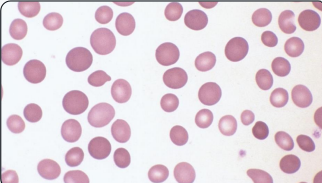 <p>what type of erythrocyte cell variation is this?</p>