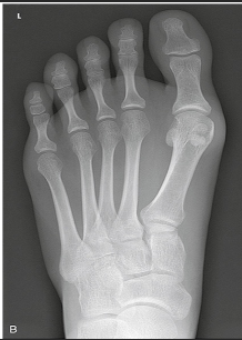 <p>Overlap of the ________ metatarsal bases should be seen.</p>