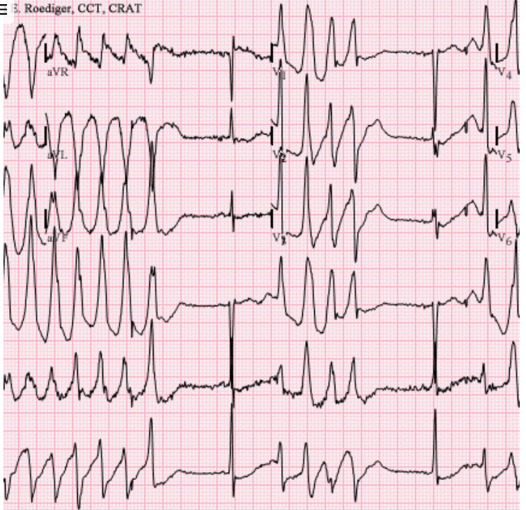 <p>prolonged QT interval</p><p>fast heart rhythm starting in the heart's lower chambers that can lead to sudden cardiac arrest</p>