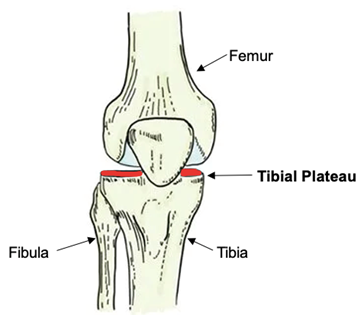 <p>Flat superior surface of the condyles. </p>