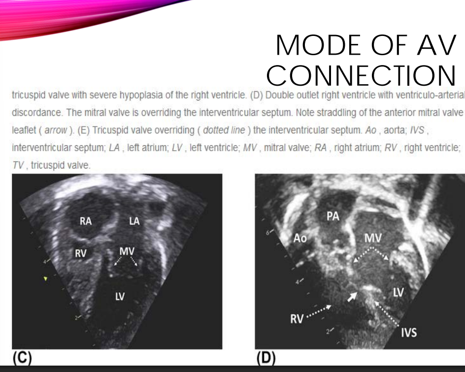 <p>UNIVENTRICULAR CONNECTIONS • </p><p>When describing the type of AV connection…we should determine whether it’s what?</p>