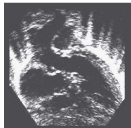 <p>How does an AVSD produce an elongated LVOT, and what appearance does it create? Name 3 views you can see this in?</p>