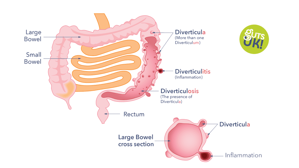 <p>a. diverticulum </p>