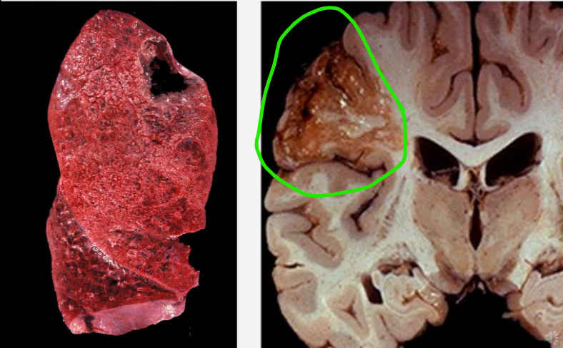 <ul><li><p>audinys skystėja ir tirpsta</p></li><li><p>ten, kur lipidų yra</p></li><li><p><strong>formuoja cistines ertmines struktūras</strong></p></li></ul><p></p>
