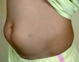 <p>how is insulin lipodystrophy prevented?</p>