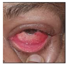 <p>-prodrome or part of a viral syndrome, URI - sore throat, History of exposure - 8 days incubation</p><p>-generally involves one eye and the second eye a few days later</p><p>-diffuse injection</p><p>-sudden onset of acute watery discharge "tearing"</p><p>-preauricular node</p><p>-some have keratitis (inflammation of cornea)</p>