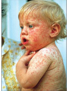 <p><strong><mark data-color="blue" style="background-color: blue; color: inherit;">Viral</mark></strong><mark data-color="blue" style="background-color: blue; color: inherit;"> skin disease</mark></p><p><strong><mark data-color="purple" style="background-color: purple; color: inherit;">[__]</mark></strong><mark data-color="purple" style="background-color: purple; color: inherit;">:</mark> <mark data-color="yellow" style="background-color: yellow; color: inherit;">also known as “Rubeola,” “hard measles,” or “red measles”</mark></p><p><mark data-color="yellow" style="background-color: yellow; color: inherit;">Causes a skin rash due to the cellular immune response to viral antigens in skin</mark></p><p><u><mark data-color="blue" style="background-color: blue; color: inherit;">Causative Agent</mark></u>: <strong><mark data-color="purple" style="background-color: purple; color: inherit;">Rubeola virus</mark></strong></p><p><u><mark data-color="blue" style="background-color: blue; color: inherit;">Spread</mark></u>: <mark data-color="purple" style="background-color: purple; color: inherit;">respiratory droplets</mark>; <strong>highly contagious</strong></p><p><u><mark data-color="blue" style="background-color: blue; color: inherit;">Confirmed by:</mark></u> <strong><mark data-color="purple" style="background-color: purple; color: inherit;">Koplik’s spots</mark></strong><mark data-color="purple" style="background-color: purple; color: inherit;">:</mark><mark data-color="yellow" style="background-color: yellow; color: inherit;"> white spots in the back of the throat</mark></p><div data-type="horizontalRule"><hr></div><p><mark data-color="yellow" style="background-color: yellow; color: inherit;">Many cases complicated by secondary infections</mark></p><p>→ Pneumonia and earaches » most common</p><p>→ <strong><mark data-color="purple" style="background-color: purple; color: inherit;">Subacute sclerosing panencephalitis (SSPE)</mark></strong>: <mark data-color="yellow" style="background-color: yellow; color: inherit;">death due to brain degradation » least common</mark></p><div data-type="horizontalRule"><hr></div><p><u><mark data-color="blue" style="background-color: blue; color: inherit;">Prevention</mark></u>: vaccination (<strong>MMR vaccine</strong>)</p><p>» prior to immunization, over 99% of population infected</p><p>» outbreaks occur due to lapses in vaccination</p>