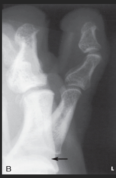 <p>Describe the patient position for the 2nd toe.</p>