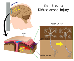 <p>What is a clinical consequence of diffuse axonal injury?</p>
