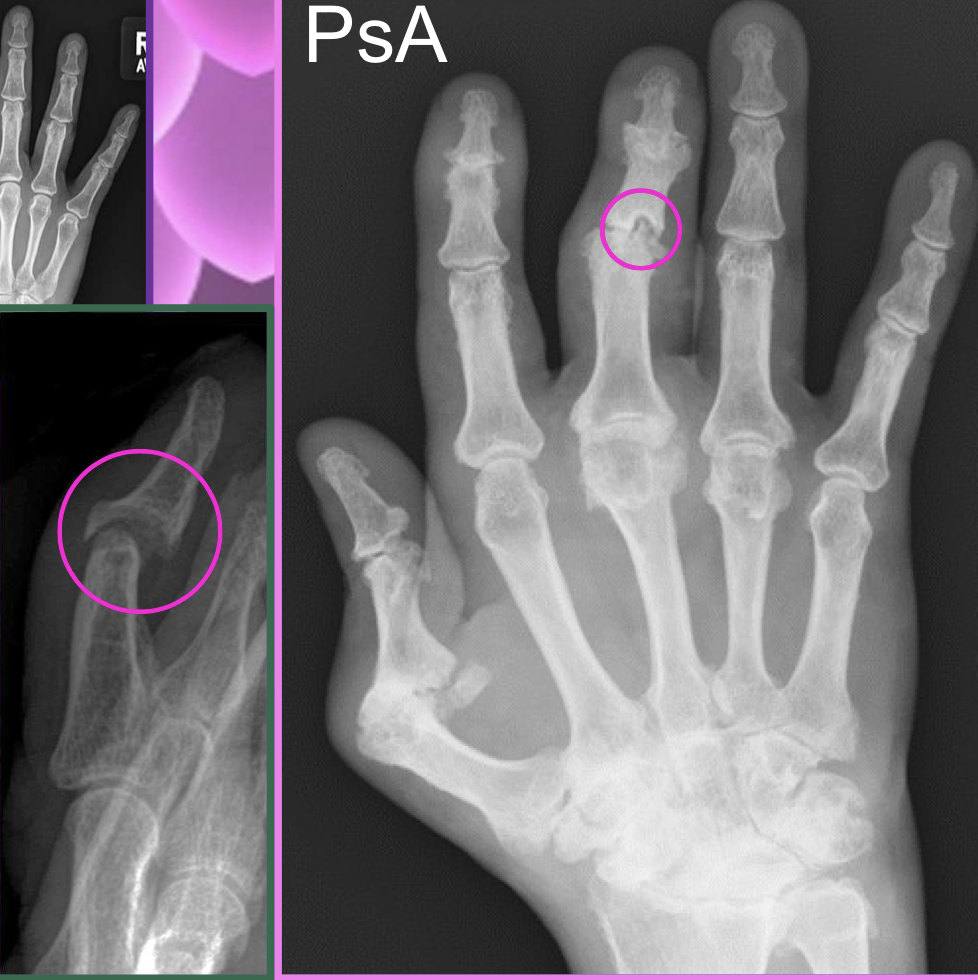 <p>What finding of PsA is found in this image</p>