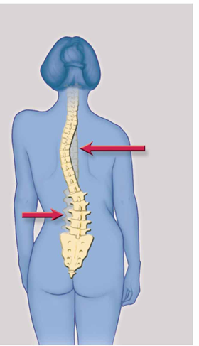 <p>Scoliosis</p>