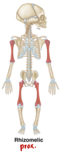 <p>shortening of <span style="color: yellow;">proximal</span> segment (humerus and femur)</p><p>**proximal=close to core of body</p>