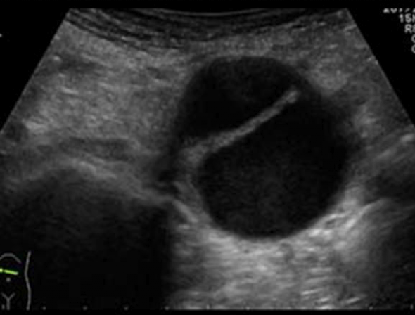 <p>when an injury to the innermost layer of aorta allows blood to flow between the layers of aortic wall, forcing the layers apart </p>