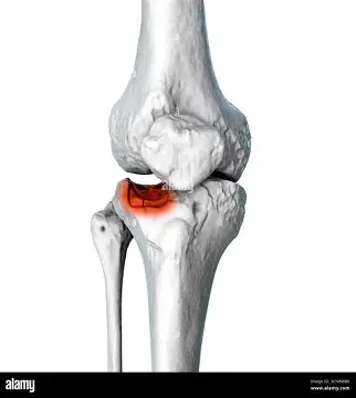 <p><span>lateral, had little u for fibula to fit, tibia, top, sticks out</span></p>