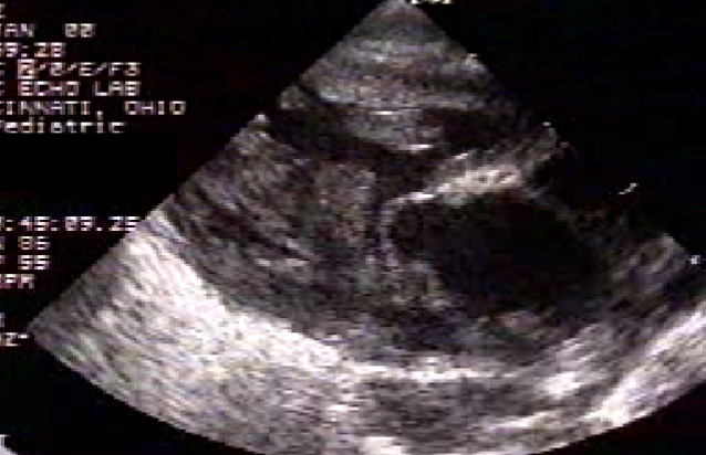 <ul><li><p>PLAX</p><ul><li><p>large overriding truncal root</p></li><li><p>VSD</p></li></ul></li><li><p>PSAX</p><ul><li><p># of leaflets present</p></li><li><p>absence of MPA is its usual location</p></li><li><p>examine truncal root for PA origin</p></li></ul></li></ul><p></p>