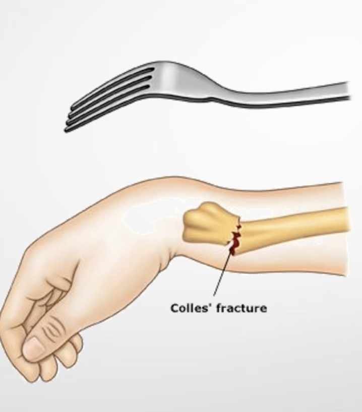 <p>radius tilts posteriorly when its fractured</p>