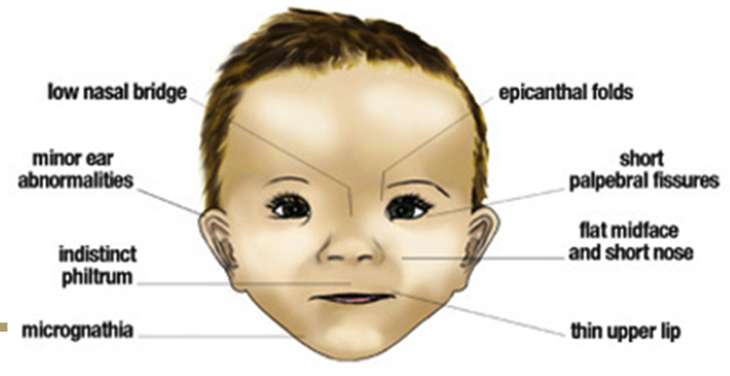 <p>caused by alcohol exposure during pregnancy, leading to permanent physical, neurologic, and developmental abnormalities</p><ul><li><p>dose-dependent</p></li></ul><p></p>