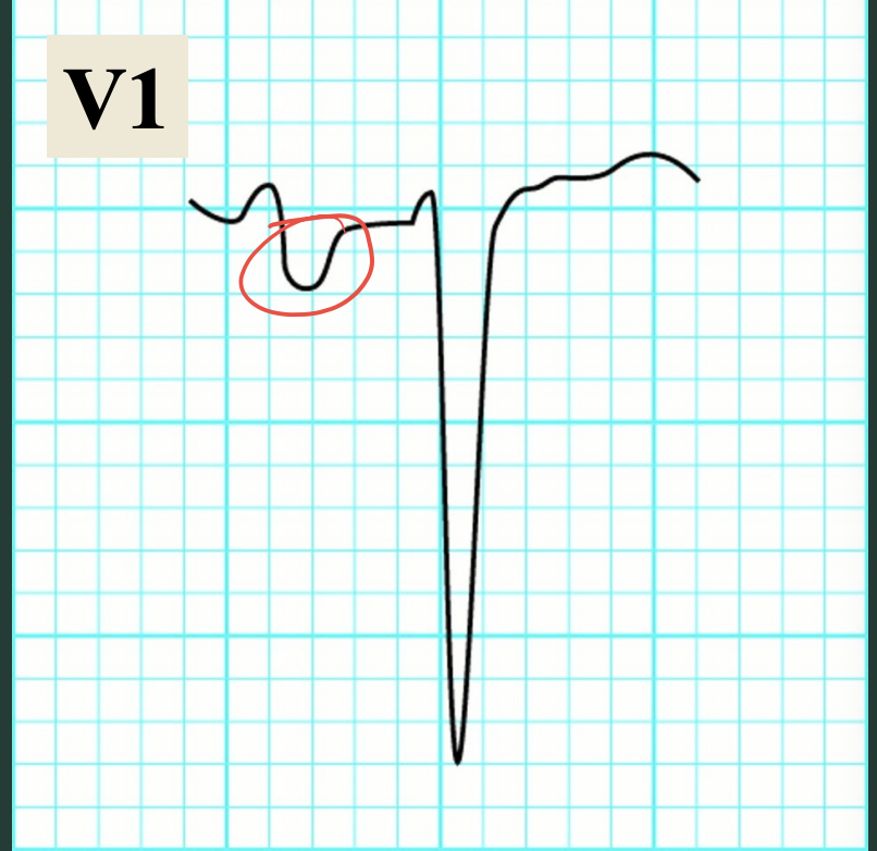 <p>What type of hypertrophy?</p>