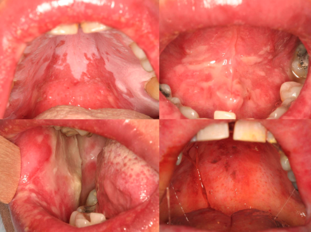<p>lichen planus (both clinically and microscopically)</p>