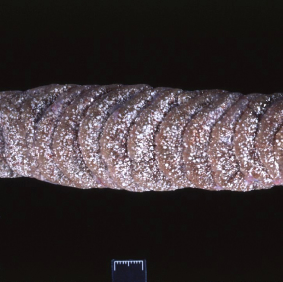 <p>Snake kidney. Name the lesion. </p>