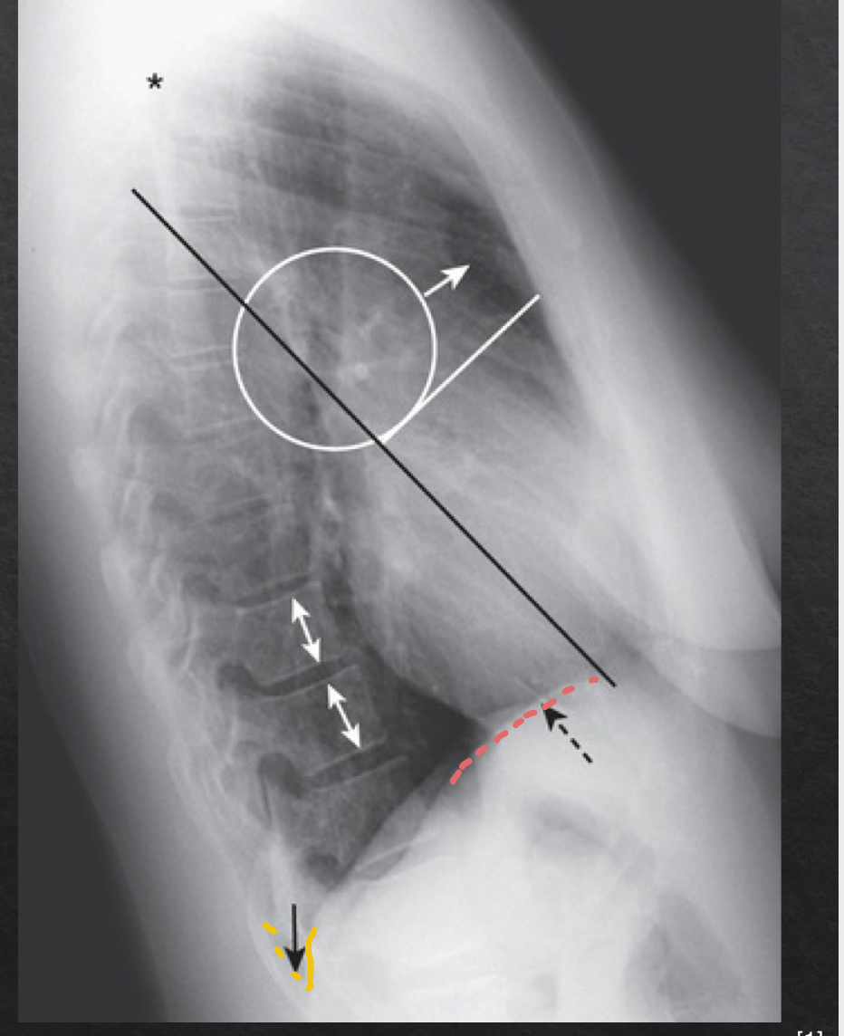 <p>NORMAL</p><ul><li><p>sharp posterior costophrenic sulci</p></li><li><p>R and L hemidiaphragm</p></li><li><p>R hemi is usually <strong>slightly higher </strong>and visible for its entire length front to back</p></li><li><p>L hemi anterior edge usually not visible (silhoueted by heart anteriorly) and posterior edge seen sharply </p></li></ul><p></p>
