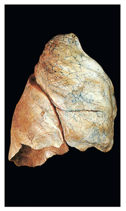 <p><span>Is this a right or left lung?</span></p>