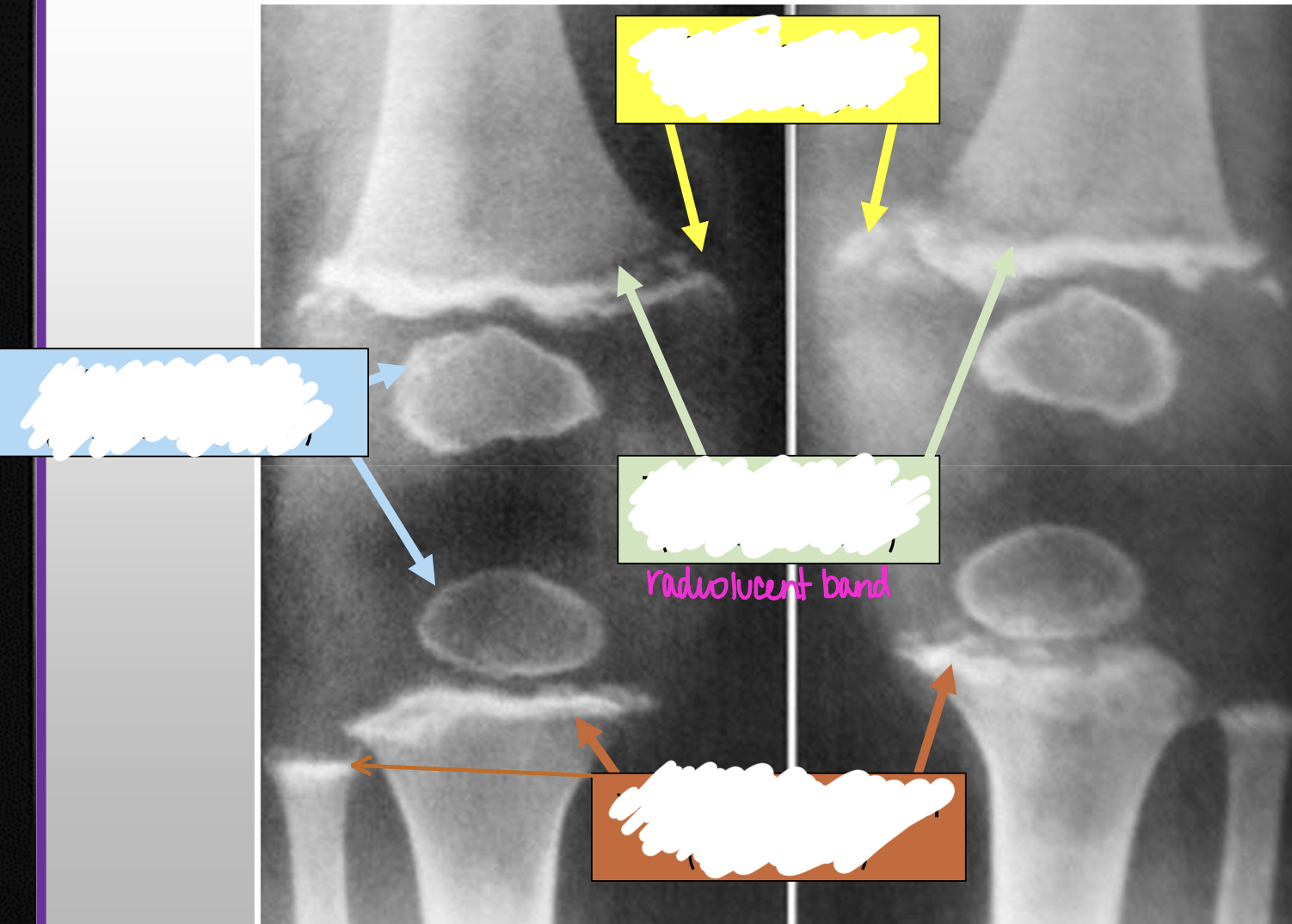 <p>What radiographic finding of Scurvy is in the blue box</p>