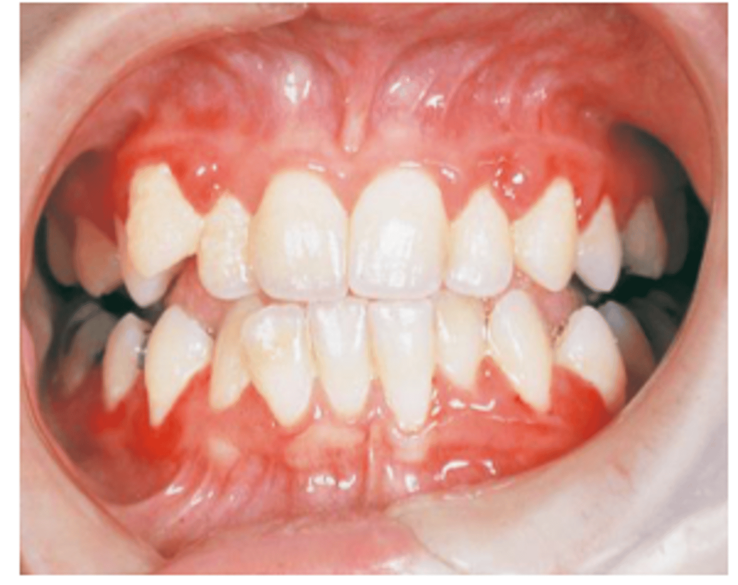 <p><br>-by decrease in the number of circulating neutrophilic leukocytes, white blood cells help fight infection and remodel the body.</p><p>-autosomal dominant</p>