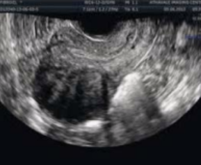 <p><span style="background-color: transparent;">What type of fibroid is depicted in this image?&nbsp;</span></p><p><span style="background-color: transparent;">a. Intramural&nbsp;</span></p><p><span style="background-color: transparent;">b. Submucosal&nbsp;</span></p><p><span style="background-color: transparent;">c. Subserosal&nbsp;</span></p><p><span style="background-color: transparent;">d. Pedunculated&nbsp;</span></p>