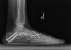 <p>Managed by PCP, non-operative</p><p>Physical therapy</p><p>Orthotics (supportive, gradual introduction)</p><p>Rarely surgery (failed all conservative options or if rigid form w no arch at all)</p>