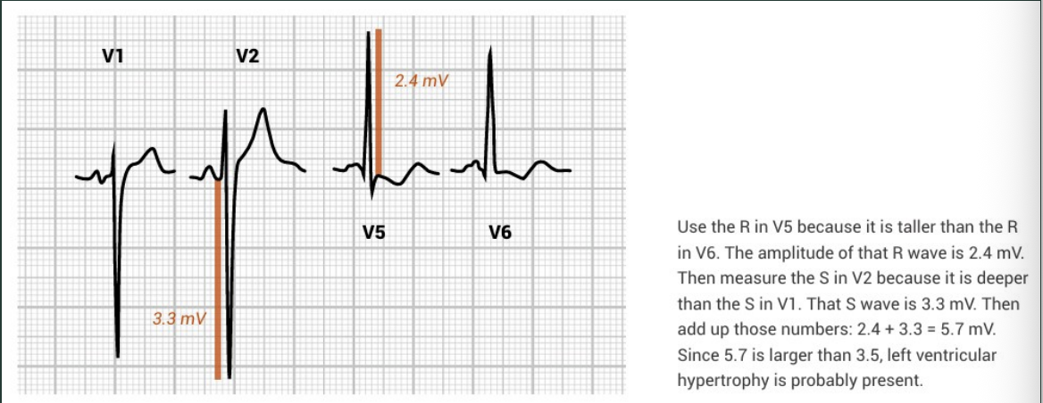 <p>add S wave in V1/V2 + R wave in V5/V6, if the sum us >35mm (35 small boxes, 7 big boxes) it’s LVH</p>