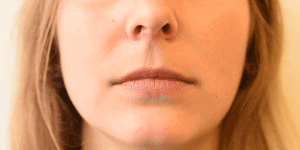 <p>Lip Tightener</p>