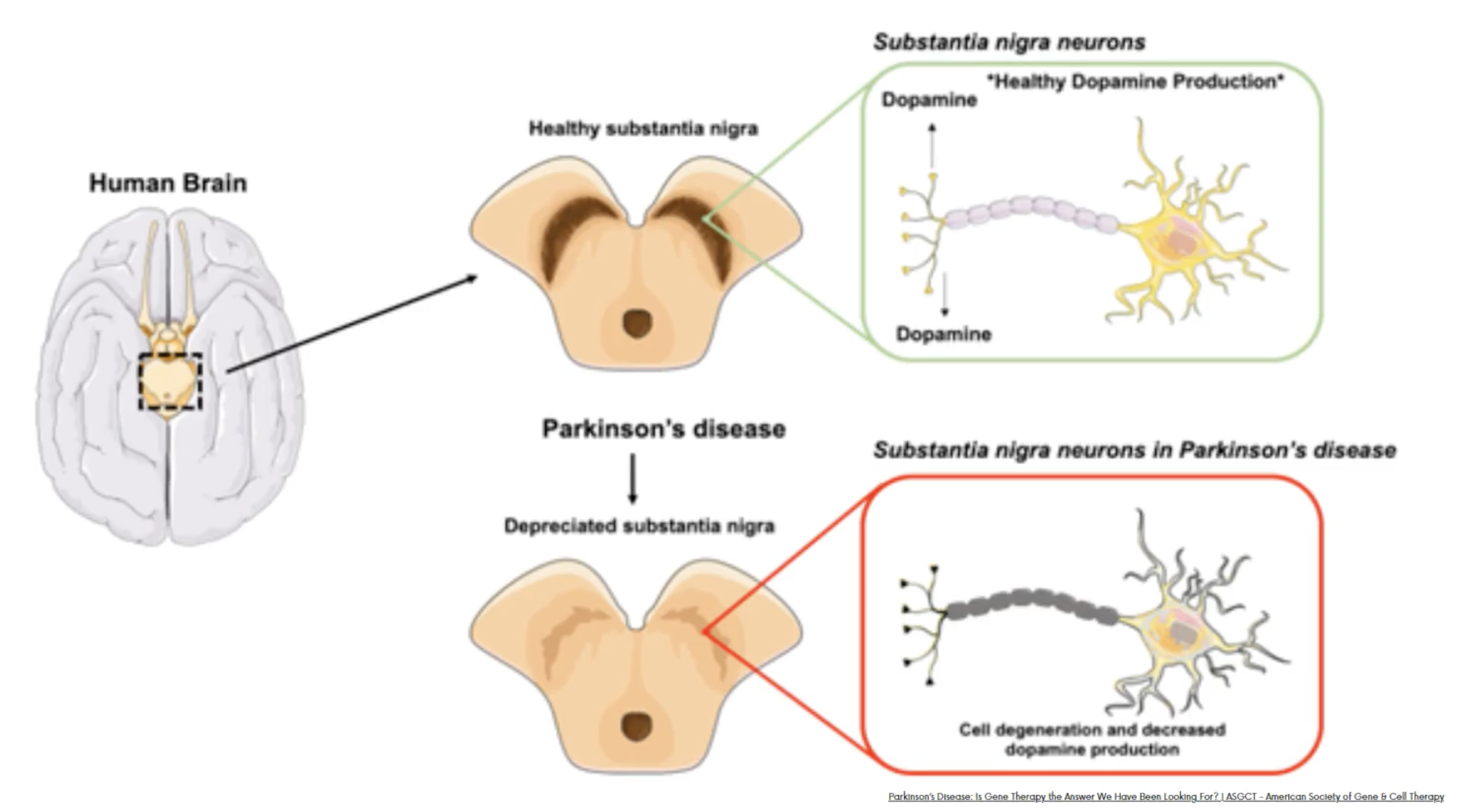 <p><mark data-color="#b4f750" style="background-color: rgb(180, 247, 80); color: inherit;">Explain parkinsons disease using this schematic<br></mark></p>