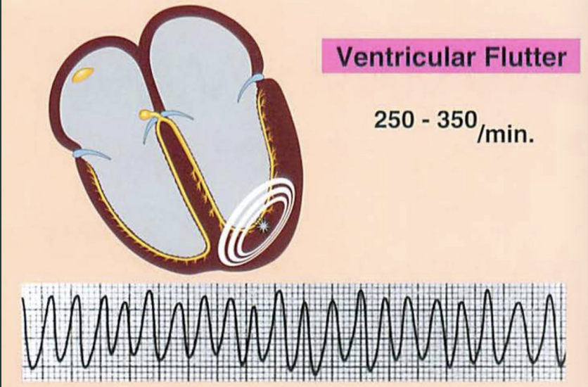 <p>What defines a ventricular flutter?</p>